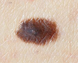 Keep an Eye on Your Moles