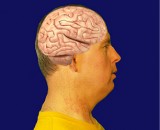 Understanding Epilepsy